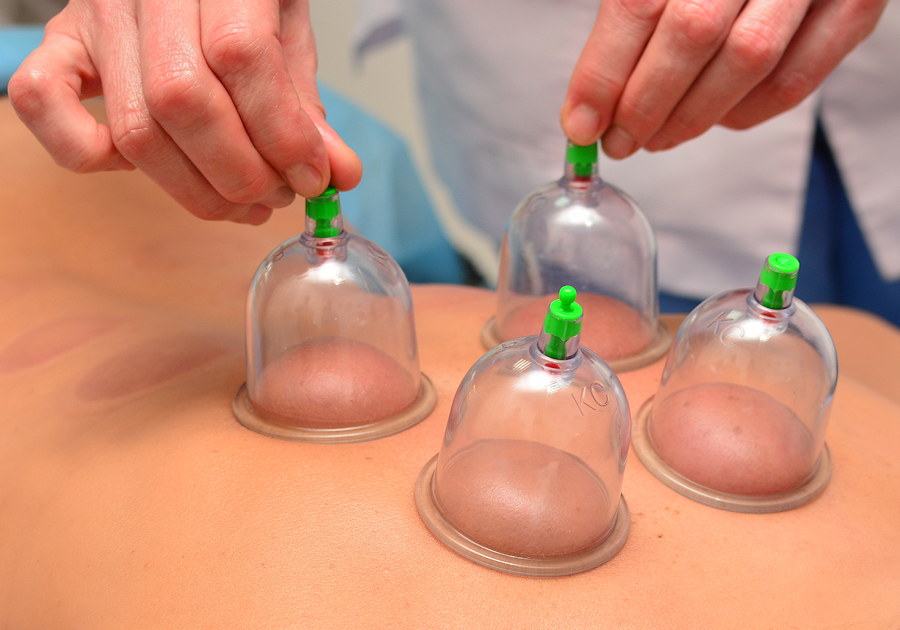 Massage Cupping Services in Windsor, CO