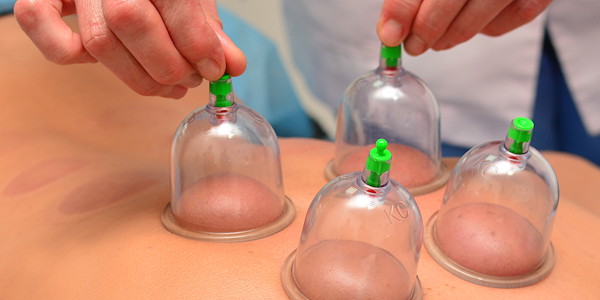 Massage Cupping Therapy